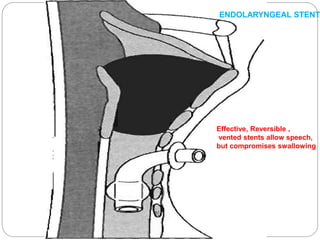 Effective, Reversible ,
vented stents allow speech,
but compromises swallowing
ENDOLARYNGEAL STENT
 