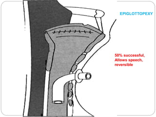 50% successful,
Allows speech,
reversible
EPIGLOTTOPEXY
 