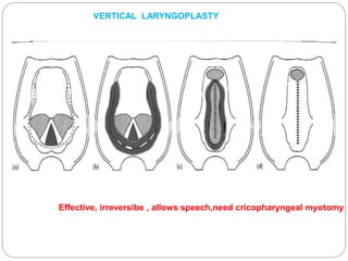 Effective, irreversibe , allows speech,need cricopharyngeal myotomy
VERTICAL LARYNGOPLASTY
 
