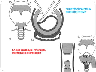 LA bed procedure, reversible,
sternohyoid interposition
SUBPERICHONDRIUM
CRICIODECTOMY
 