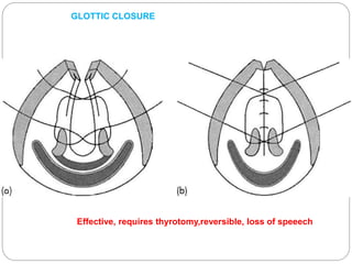 Effective, requires thyrotomy,reversible, loss of speeech
GLOTTIC CLOSURE
 