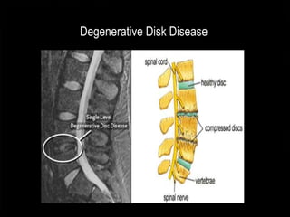 Inoperable Disc Intractable Pain | PPTX