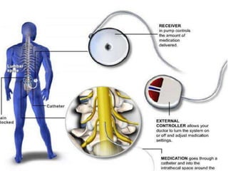 Intractable Pain | PPTX