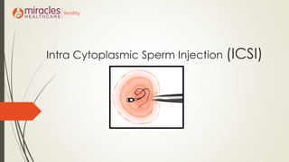 Intra Cytoplasmic Sperm Injection (ICSI)
 