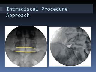 Intradiscal procedures | PPT