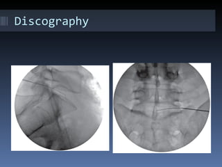 Intra Disc Injection Intradiscal procedures | PPT