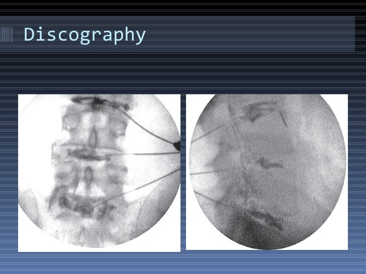 Discography Procedure