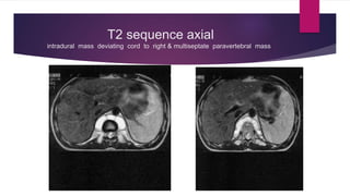 T2 sequence axial
intradural mass deviating cord to right & multiseptate paravertebral mass
 
