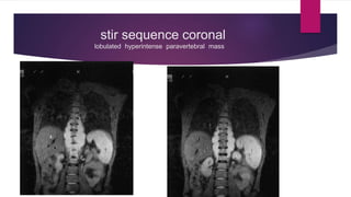 stir sequence coronal
lobulated hyperintense paravertebral mass
 
