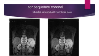 stir sequence coronal
lobulated paravertebral hyperintense mass
 