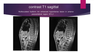 contrast T1 sagittal
Multloculated fusiform rim enhanced hypointense lesion in anterior
paravertebral region D7-L1
 