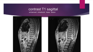 contrast T1 sagittal
enhanced intradural mass lesion
 