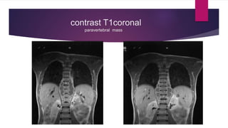 contrast T1coronal
paravertebral mass
 