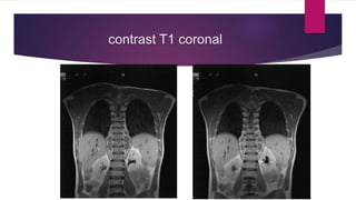 contrast T1 coronal
 