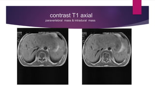 contrast T1 axial
paravertebral mass & intradural mass
 