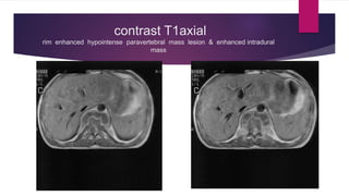 contrast T1axial
rim enhanced hypointense paravertebral mass lesion & enhanced intradural
mass
 
