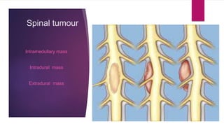 Spinal tumour
Intramedullary mass
Intradural mass
Extradural mass
 
