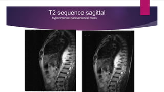 T2 sequence sagittal
hyperintense paravertebral mass
 