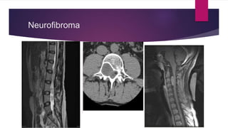 Neurofibroma
 
