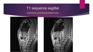 T1 sequence sagittal
hypointense spinal & paravertebral mass
 