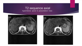T2 sequence axial
hyperintense spinal & paravertebral mass
 