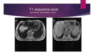 Intradural extramedullary mass - a case on  MRI Slide 11