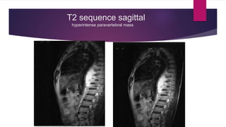 Intradural extramedullary mass - a case on  MRI Slide 3