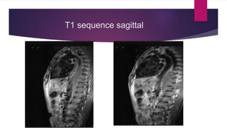 Intradural extramedullary mass - a case on  MRI Slide 7
