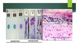 Intraepithelial Neoplasia of cervix in women | PPTX