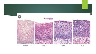 Intraepithelial Neoplasia of cervix in women | PPTX