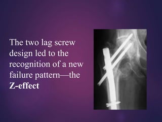 INTRAMEDULLARY NAILING: RECENT ADVANCES AND FUTURE TRENDS | PPTX