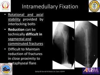 Intramedullary Fixation
•
•
•
Rotational and axial
stability provided by
interlocking bolts
Reduction can be
technically difficult in
segmental and
comminuted fractures
Difficult to Maintain
reduction of fractures
in close proximity to
metaphyseal flare
bahaa Ali Kornah-Al-Azhar Un. Cairo -EGYPT
 