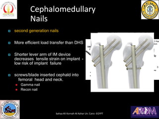 Cephalomedullary
Nails
 second generation nails
 More efficient load transfer than DHS
 Shorter lever arm of IM device
decreases tensile strain on implant -
low risk of implant failure
 screws/blade inserted cephald into
femoral head and neck.
◼ Gamma nail
◼ Recon nail
bahaa Ali Kornah-Al-Azhar Un. Cairo -EGYPT
 