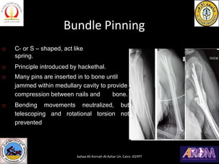 Bundle Pinning
 C- or S – shaped, act like
spring.
 Principle introduced by hackethal.
 Many pins are inserted in to bone until
jammed within medullary cavity to provide
compression between nails and bone.
 Bending movements neutralized, but
telescoping and rotational torsion not
prevented
bahaa Ali Kornah-Al-Azhar Un. Cairo -EGYPT
 
