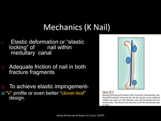 Mechanics (K Nail)
 Elastic deformation or “elastic
locking” of nail within
medullary canal
 Adequate friction of nail in both
fracture fragments
 To achieve elastic impingement-
 “V” profile or even better “clover-leaf”
design.
bahaa Ali Kornah-Al-Azhar Un. Cairo -EGYPT
 