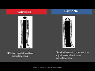 Solid Nail Elastic Nail
❑Not occupy full width of
medullary canal
❑Nail with elastic cross section
adjust to constrictions of
medullary canal.
bahaa Ali Kornah-Al-Azhar Un. Cairo -EGYPT
 