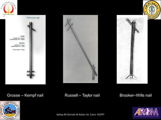 Grosse – Kempf nail Russell – Taylor nail Brooker–Wills nail
bahaa Ali Kornah-Al-Azhar Un. Cairo -EGYPT
 