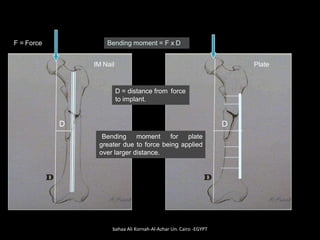 D
F = Force Bending moment = F x D
D
PlateIM Nail
Bending moment for plate
greater due to force being applied
over larger distance.
D = distance from force
to implant.
bahaa Ali Kornah-Al-Azhar Un. Cairo -EGYPT
 