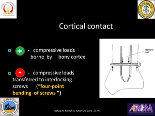 Cortical contact
 - compressive loads
borne by bony cortex
 compressive loads
transferred to interlocking
screws (“four-point
bending of screws ”)
+
- -
bahaa Ali Kornah-Al-Azhar Un. Cairo -EGYPT
 