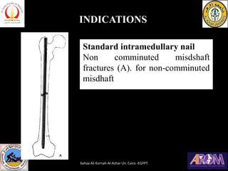 INDICATIONS
Standard intramedullary nail
Non comminuted misdshaft
fractures (A). for non-comminuted
misdhaft
bahaa Ali Kornah-Al-Azhar Un. Cairo -EGYPT
 