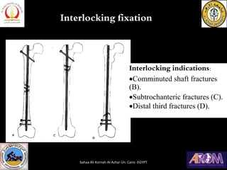 Interlocking fixation
Interlocking indications:
•Comminuted shaft fractures
(B).
•Subtrochanteric fractures (C).
•Distal third fractures (D).
bahaa Ali Kornah-Al-Azhar Un. Cairo -EGYPT
 