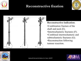 Reconstructive fixation
Reconstructive indication:
•Combination fracture of the
shaft and neck (E).
•Intertrochanteric fractures (F).
•Combined intertrochanteric and
subtrochanteric fractures (G).
•Reconstruction following
tumour resection.
bahaa Ali Kornah-Al-Azhar Un. Cairo -EGYPT
 