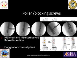 Poller /blocking screws
 Corrects mal-alignment.
 Centers IM nail.
 Planned and inserted before
IM nail insertion.
 Saggital or coronal plane.
bahaa Ali Kornah-Al-Azhar Un. Cairo -EGYPT
 