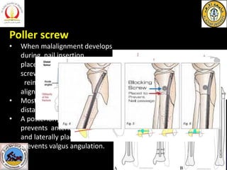 Poller screw
• When malalignment develops
during nail insertion,
placement of blocking (Poller
screws) screw, and nail
reinsertion improves
alignment.
• Most reliable in proximal and
distal shaft fractures of tibia.
• A posteriorly placed screw
prevents anterior angulation
and laterally placed screw
prevents valgus angulation.
 
