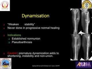 Dynamisation
❑ “Weaken stability”
❑ Never done in progressive normal healing
❑ Indications
❑ Established nonnunion
❑ Pseudoarthrosis
❑ Caution: premature dynamization adds to
shortening, instability and non-union.
bahaa Ali Kornah-Al-Azhar Un. Cairo -EGYPT
 