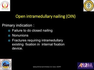 Open intramedullary nailing (OIN)
Primary indication :
 Failure to do closed nailing
 Nonunions
 Fractures requiring intramedullary
existing fixation in internal fixation
device.
bahaa Ali Kornah-Al-Azhar Un. Cairo -EGYPT
 