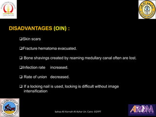 DISADVANTAGES (OIN) :
❑Skin scars
❑Fracture hematoma evacuated.
❑ Bone shavings created by reaming medullary canal often are lost.
❑Infection rate increased.
❑ Rate of union decreased.
❑ If a locking nail is used, locking is difficult without image
intensification
bahaa Ali Kornah-Al-Azhar Un. Cairo -EGYPT
 