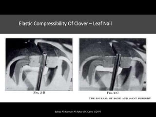 Elastic Compressibility Of Clover – Leaf Nail
bahaa Ali Kornah-Al-Azhar Un. Cairo -EGYPT
 
