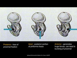 Posterior - loss of
proximal fixation
Ideal - posterior portion
of piriformis fossa
Anterior - generates
huge forces, can ...