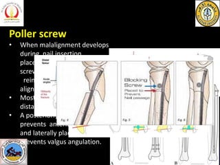 Poller screw
• When malalignment develops
during nail insertion,
placement of blocking (Poller
screws) screw, and nail
rei...